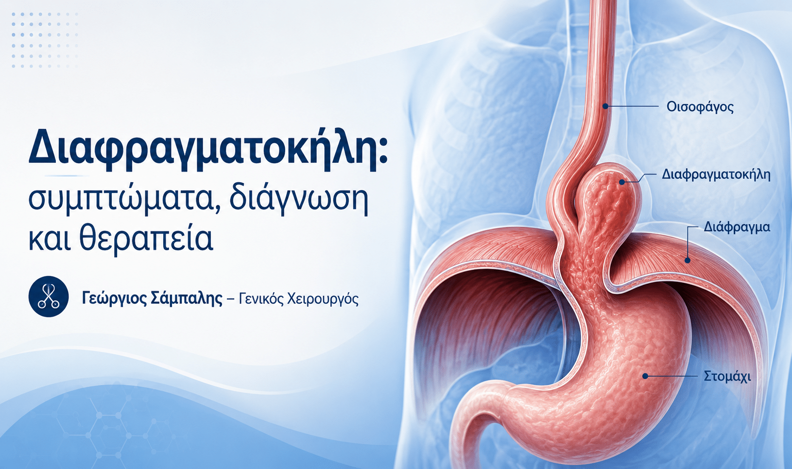 Διάφραγματοκήλη: διάγραμμα με οισοφάγο, διάφραγμα και στομάχι