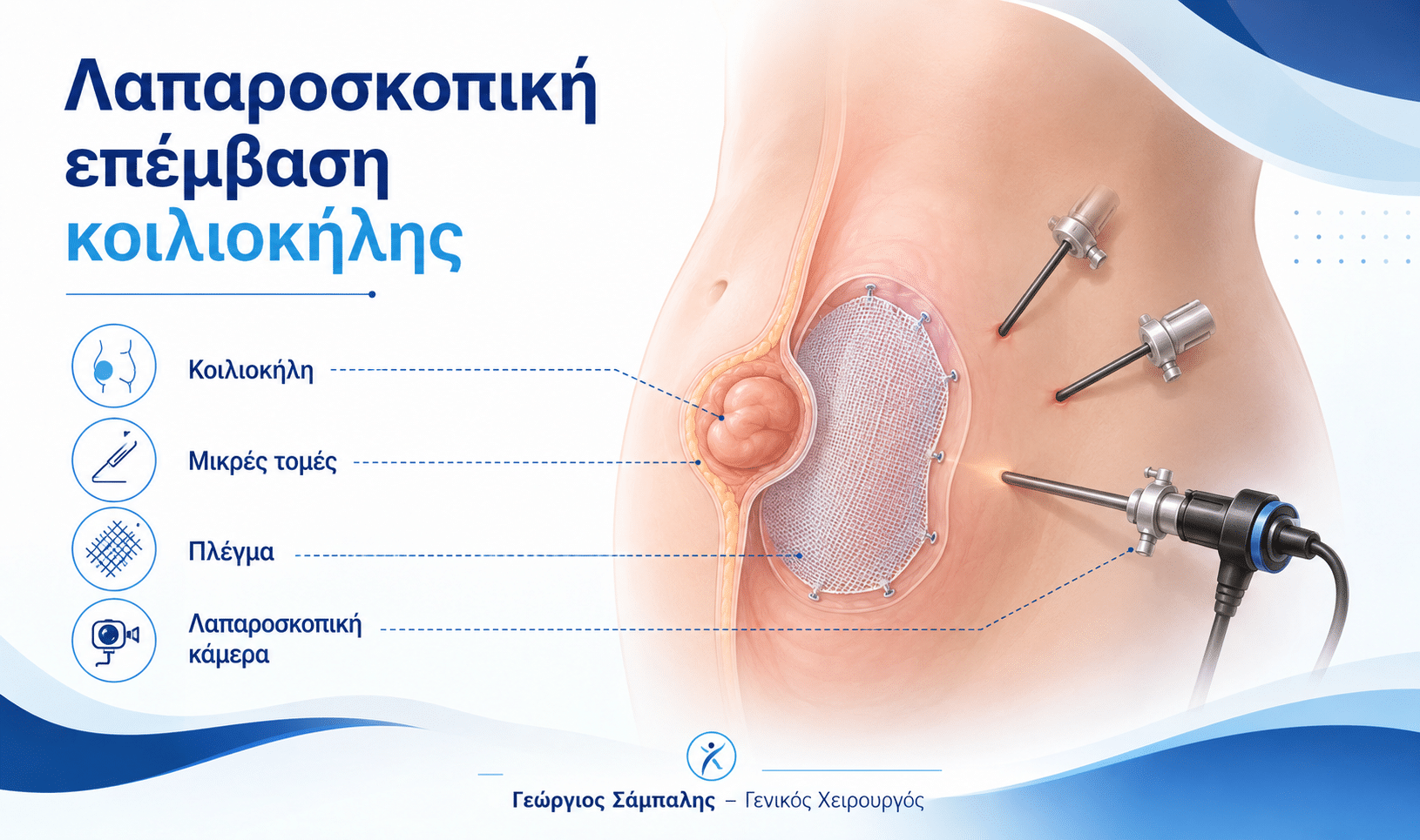 Λαπαροσκοπική επέμβαση κοιλιοκήλης με μικρές τομές και πλέγμα στο κοιλιακό τοίχωμα