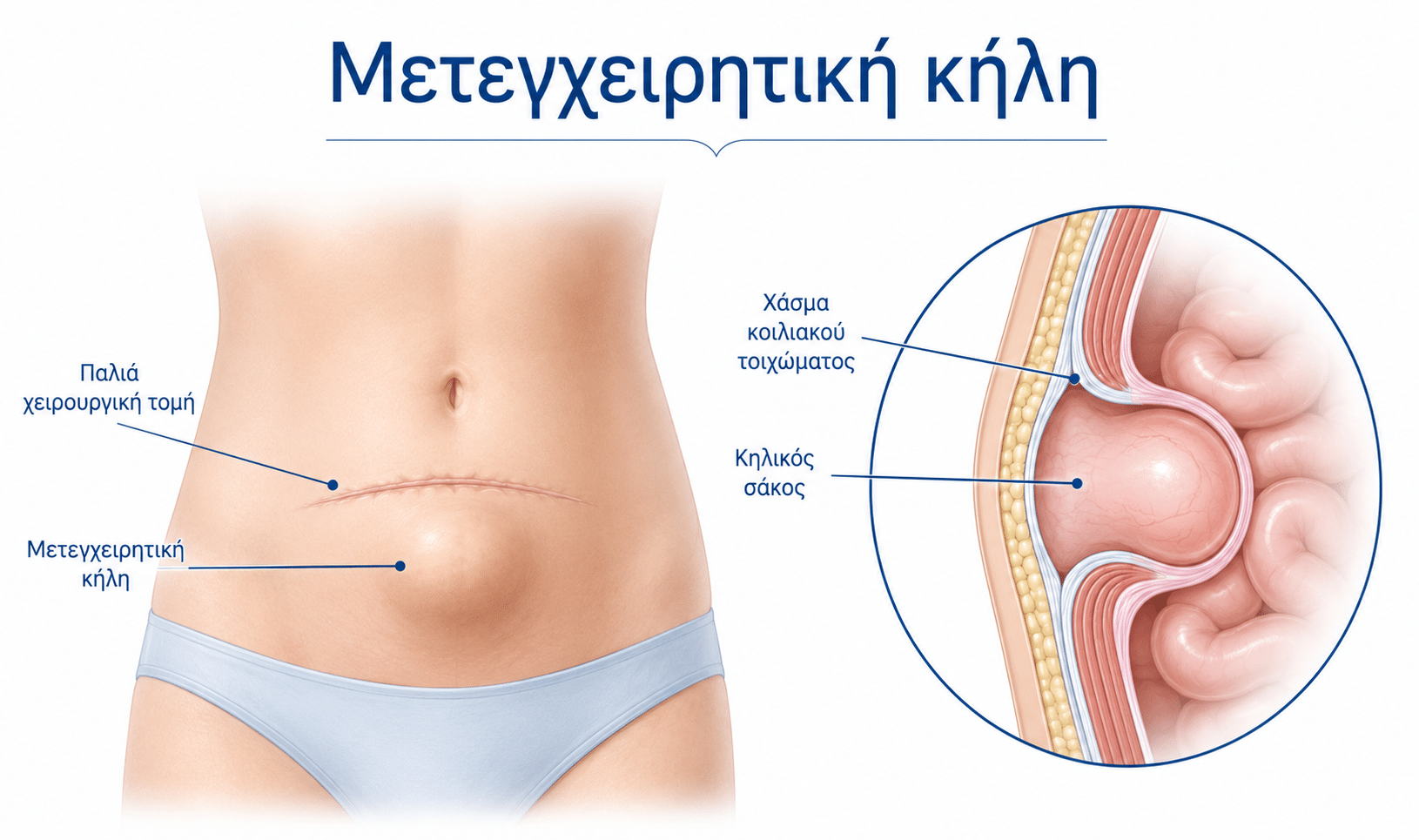 Μετεγχειρητική κήλη σε παλιά χειρουργική τομή με χάσμα στο κοιλιακό τοίχωμα