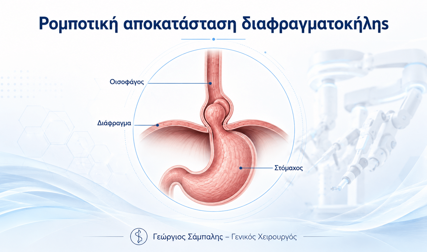 Ρομποτική αποκατάσταση διαφραγματοκήλης με da Vinci και απεικόνιση οισοφάγου, στομάχου και διαφράγματος