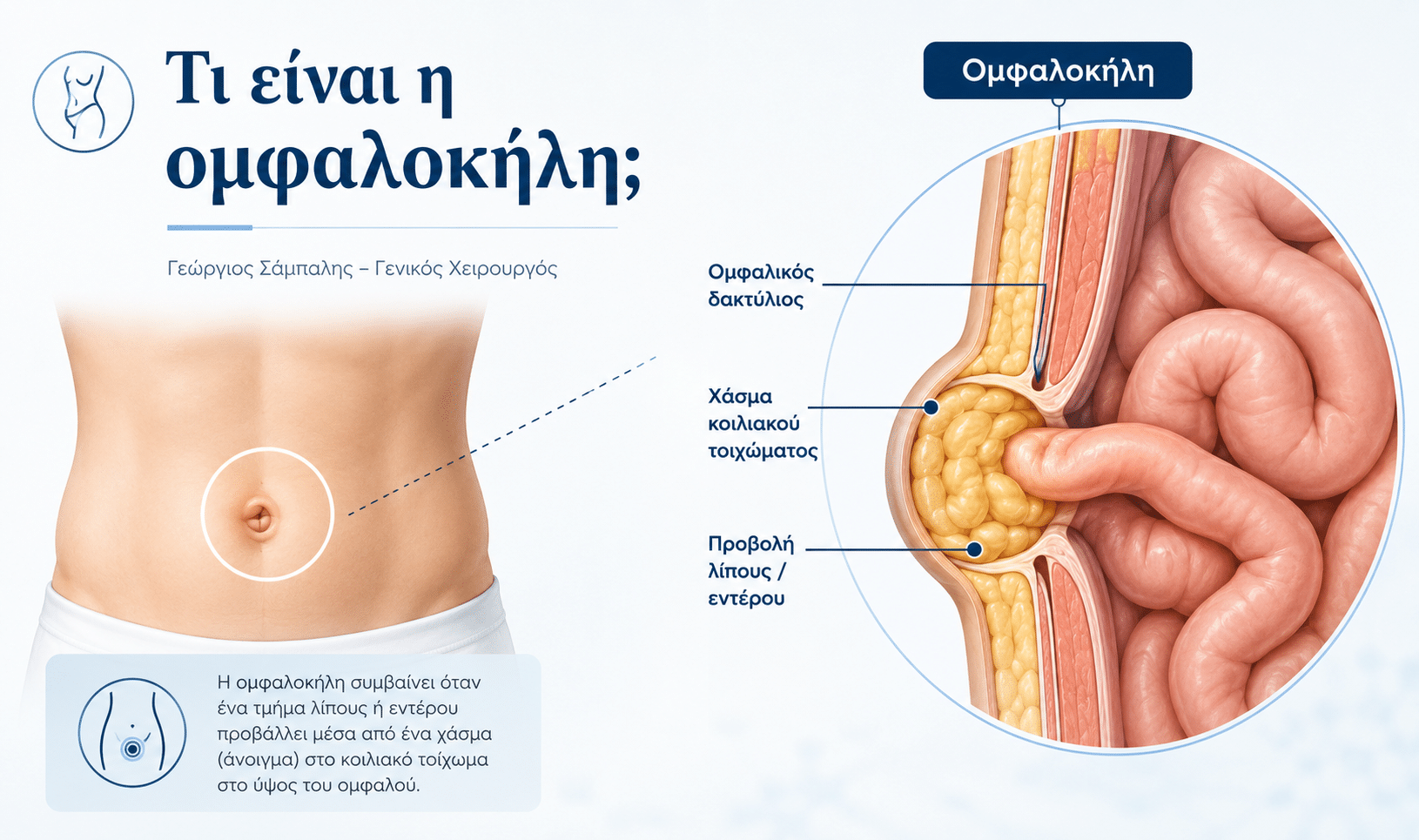 Τι είναι η ομφαλοκήλη - ανατομική απεικόνιση
