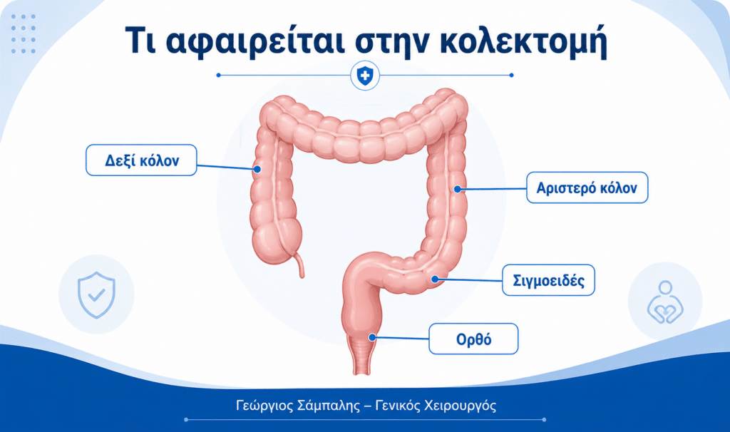 Τμήματα παχέος εντέρου που μπορεί να αφαιρεθούν σε κολεκτομή