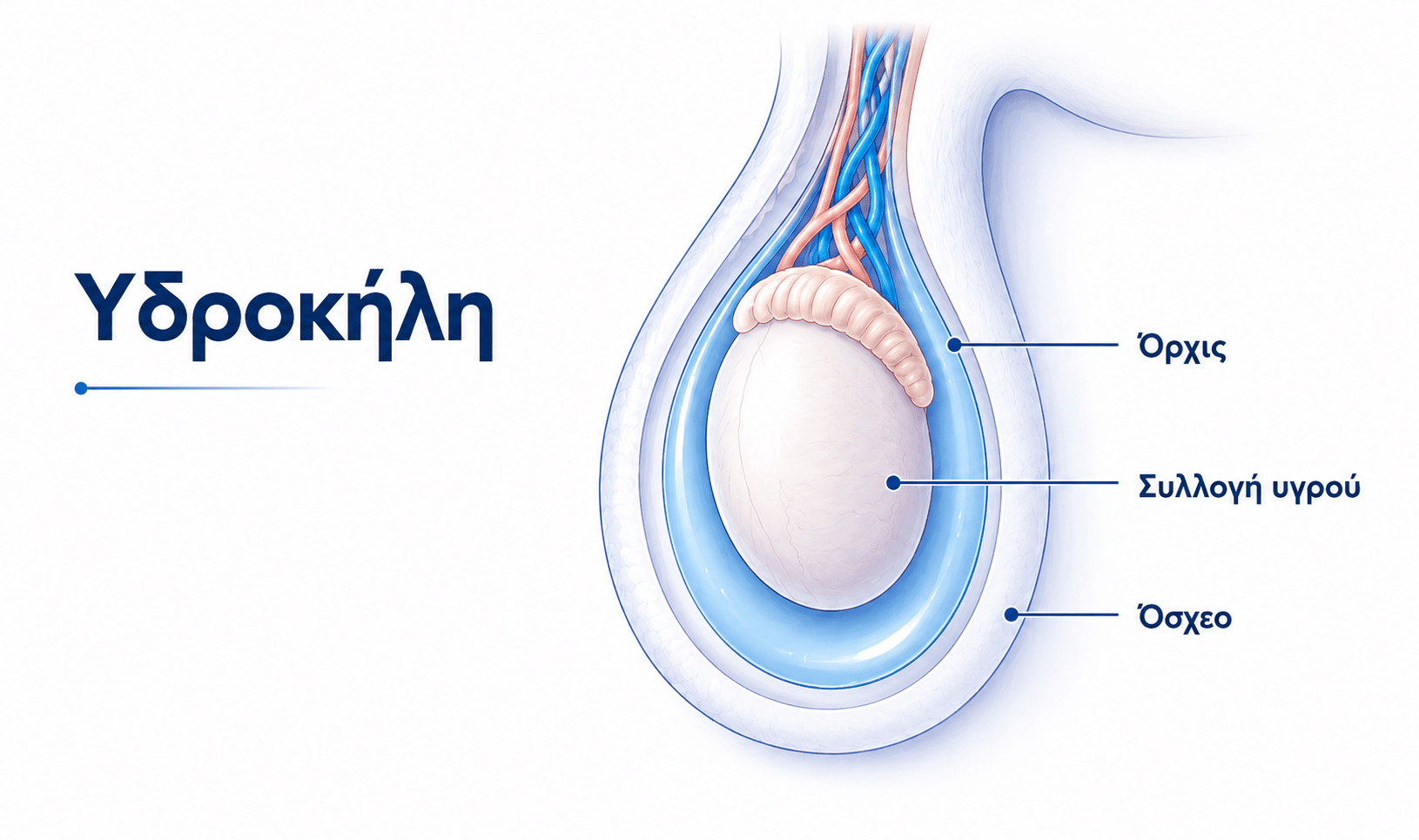 Υδροκήλη με συλλογή υγρού γύρω από τον όρχι και πρήξιμο στο όσχεο