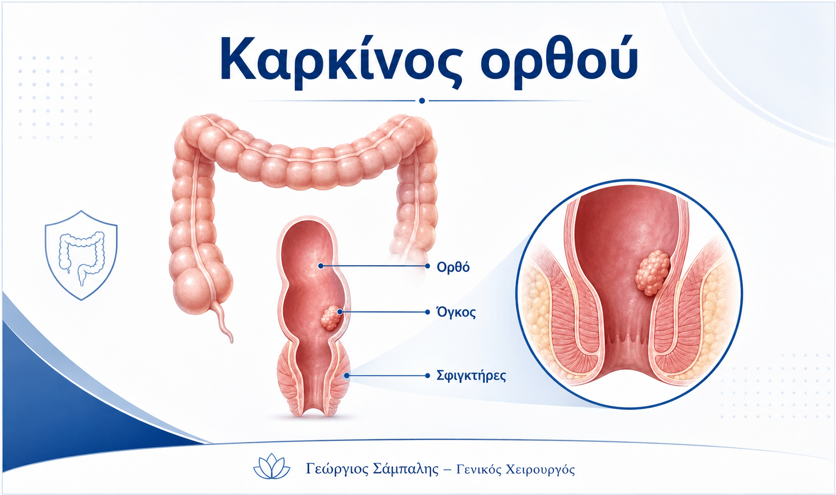 Καρκίνος ορθού – ανατομία του ορθού και θέση του όγκου
